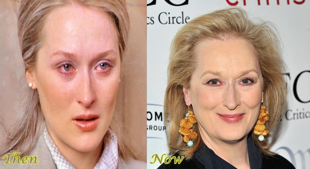 Meryl-Streep-Plastic-Surgery