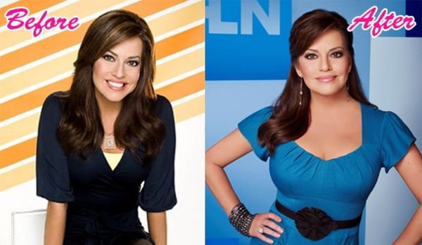 robin-meade-plastic-surgery-before-after