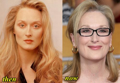 Maryl-Streep-Plastic-Surgery-Before-and-After