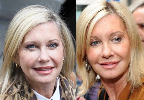 Olivia-Newton-John-Plastic-Surgery-Before-And-After